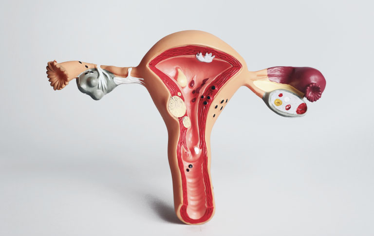Female reproductive system model illustrating uterus, ovaries and fallopian tubes for reproductive surgery, Dr Kate Burston Newcastle gynaecologist and fertility specialist